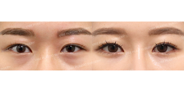 #뒤트임 #밑트임 #눈밑지방재배치