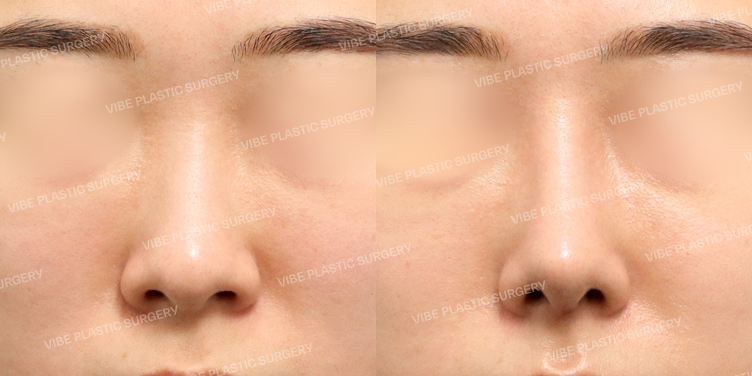 #콧대 #코끝 #복코 #비순각교정 #이물질제거