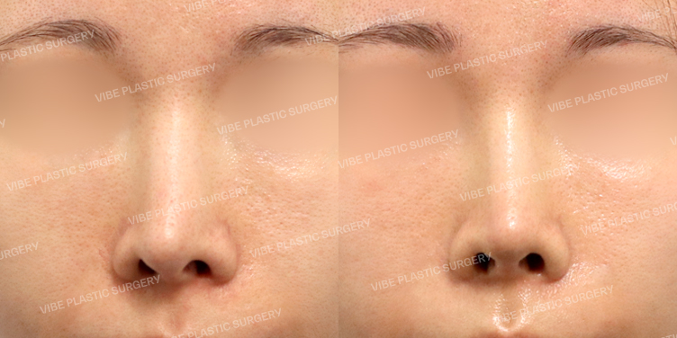 #3번째코재수술 #무보형물코성형 #기증늑 #비절개콧볼축소 #비공내리기 #휜코 #콧날개보톡스