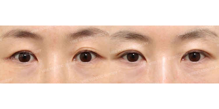 #상안검 #자연유착쌍꺼풀