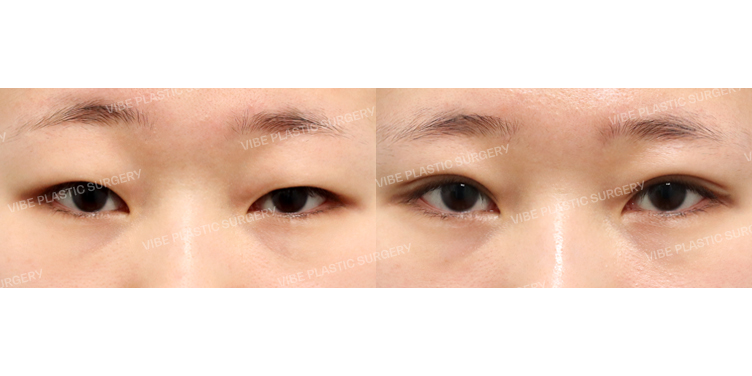 #부분절개눈매교정