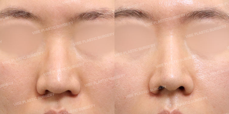 #무보형물코성형 #매부리코 #절골 #긴코 #복코 #비중격