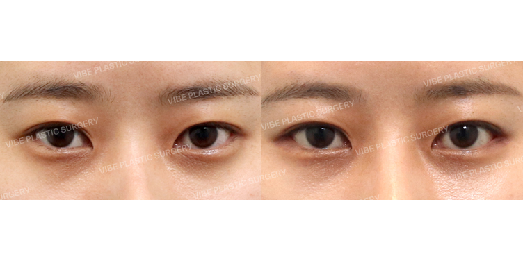 #뒤밑트임(재수술)