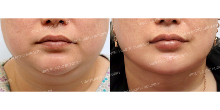 #초음파지방흡입(이중턱,턱라인,팔자위,앞볼) #심부볼지방제거 #침샘보톡스
