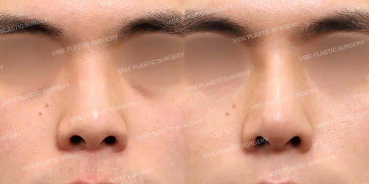 #무보형물 #매부리코 #짧은코 #비중격