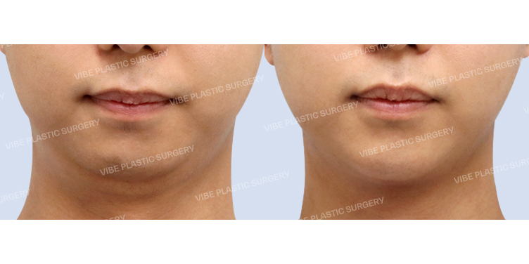 #초음파지방흡입(이중턱,턱라인) #목거상(이중턱근육묶기)