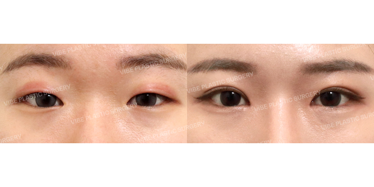 #비절개눈매교정 #앞트임