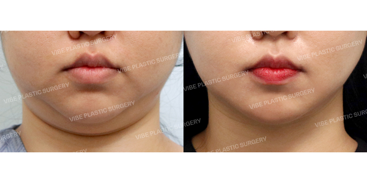 #초음파지방흡입(이중턱,턱라인) #목거상(이중턱근육묶기) #심부볼지방제거