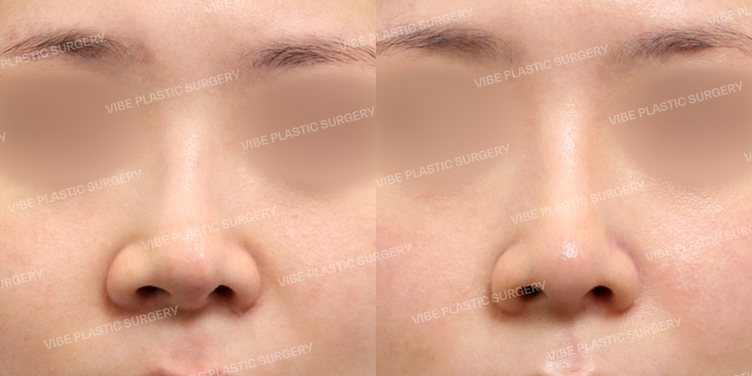 #코재수술 #콧볼축소 #휜코 #자가늑