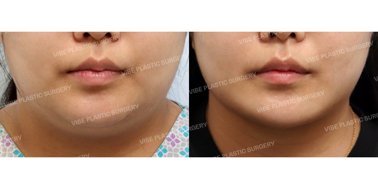 #초음파지방흡입(이중턱,턱라인) #실리프팅