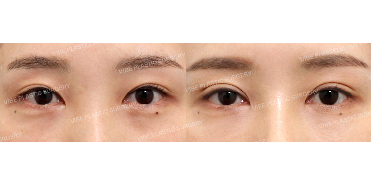 #자연유착쌍꺼풀(재수술)