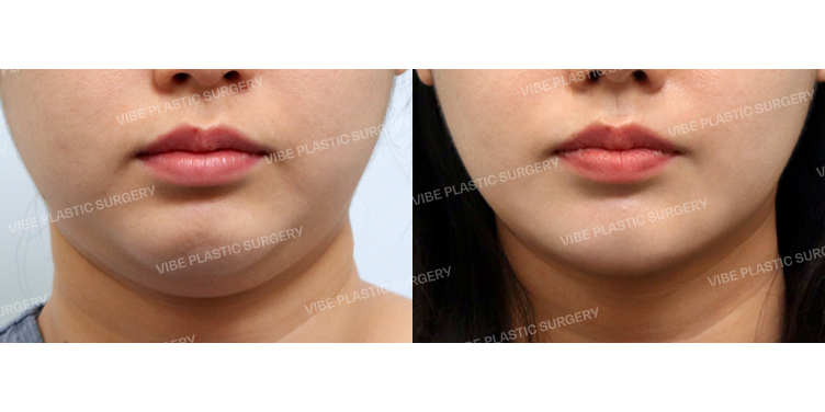 #초음파지방흡입(이중턱,턱라인) #사각턱보톡스