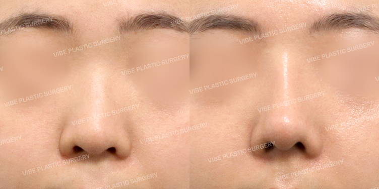 #콧대 #코끝 #비중격 #기증늑 #복코 #비순각교정 #절골