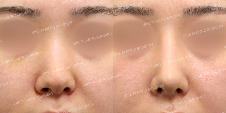 #콧대 #코끝 #기증늑 #기능코 #매부리코 #휜코 #복코