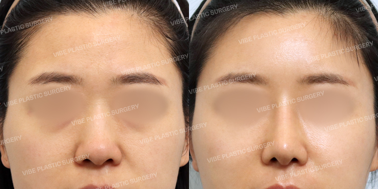 #지방이식(이마,관자,눈밑,앞볼,팔자) #보톡스 #콧대 #코끝 #매부리코 #복코 #비순각교정 #비중격 #기증늑