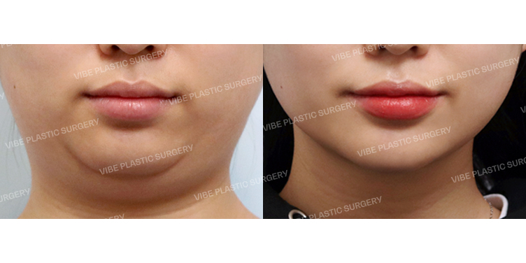 #초음파지방흡입(이중턱,턱라인) #슈링크 #턱끝필러