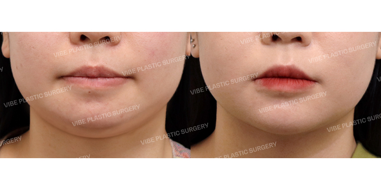 #초음파지방흡입(이중턱, 턱라인, 앞볼, 팔자위)