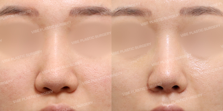 #코재수술 #비순각교정 #복코 #절골 #기증늑