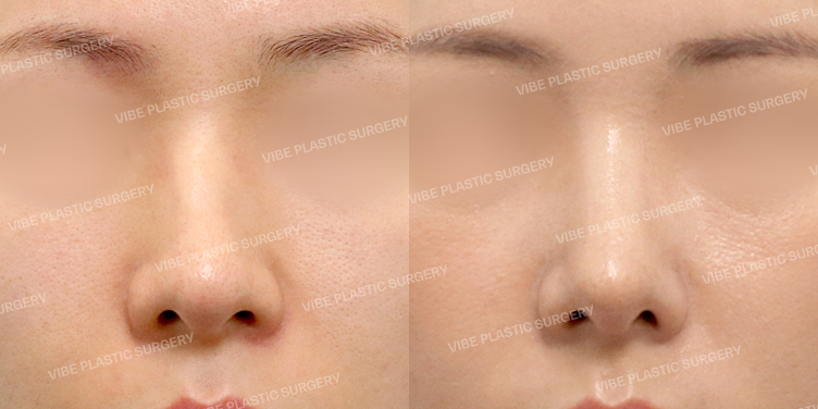 #무보형물코성형 #비중격 #기증늑 #매부리코 #절골 #휜코 #비순각교정