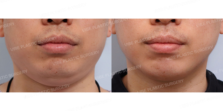 #초음파지방흡입(이중턱,턱라인)