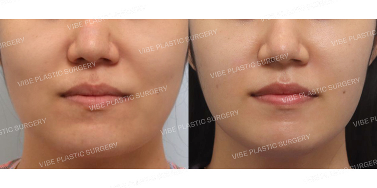 #초음파지방흡입(광대,앞볼,턱라인)