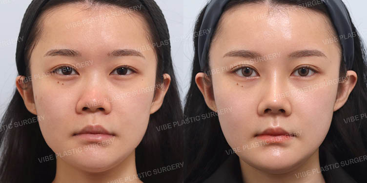 #콧대 #코끝 #절골 #비주교정 #복코 #짧은코 #비절개콧볼축소 #기증늑