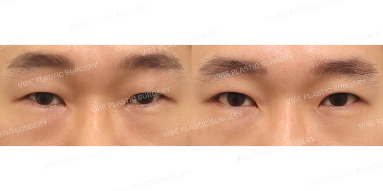 #절개눈매교정 #뒤트임 #밑트임