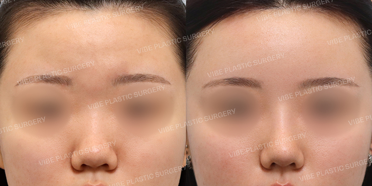 #지방이식 #콧대 #코끝