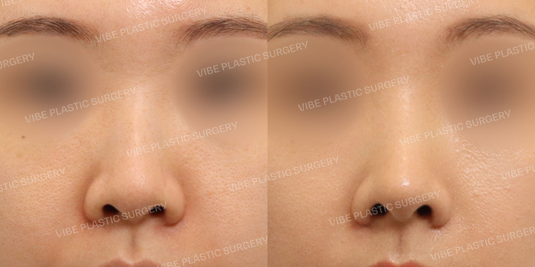 #무보형물 #매부리코 #짧은코 #코끝교정