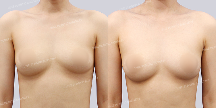 #지방이식(가슴)