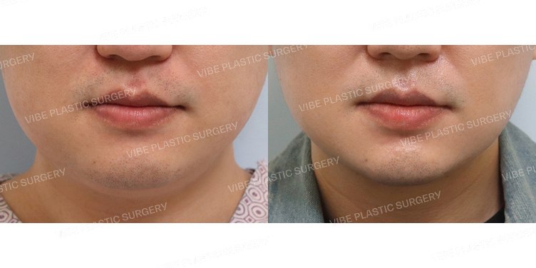 #초음파지방흡입(이중턱,턱라인) #심부볼지방제거