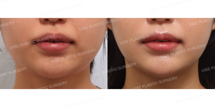 #초음파지방흡입(이중턱,턱라인)