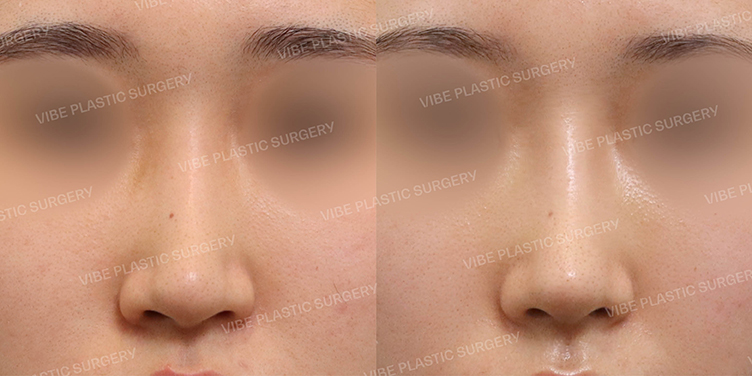 #화살코 #긴코 #비순각교정