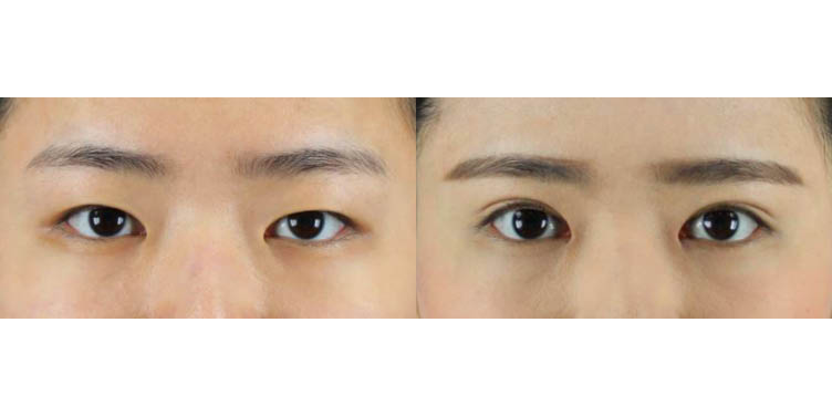 #부분절개눈매교정