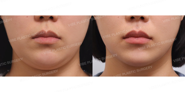 #초음파지방흡입(이중턱,턱라인)