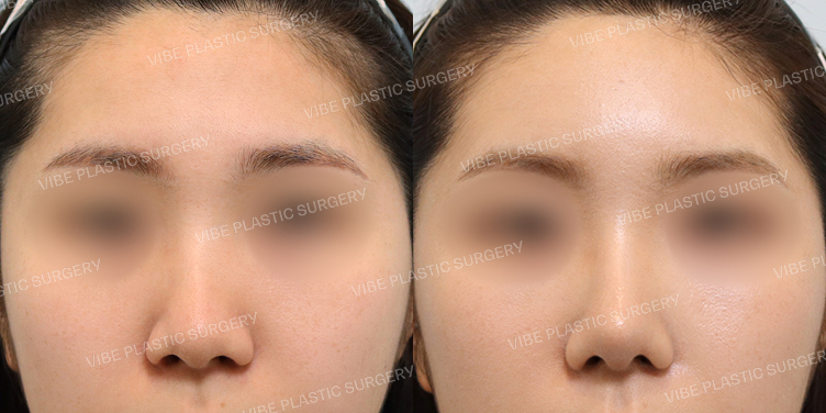 #무보형물 #매부리교정 #복코 #비순각교정 #자가미세지방이식