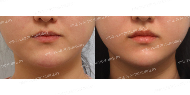 #초음파지방흡입(이중턱,턱라인) #입술필러