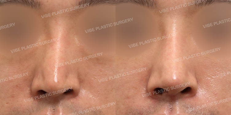 #재수술 #휜코 #코끝