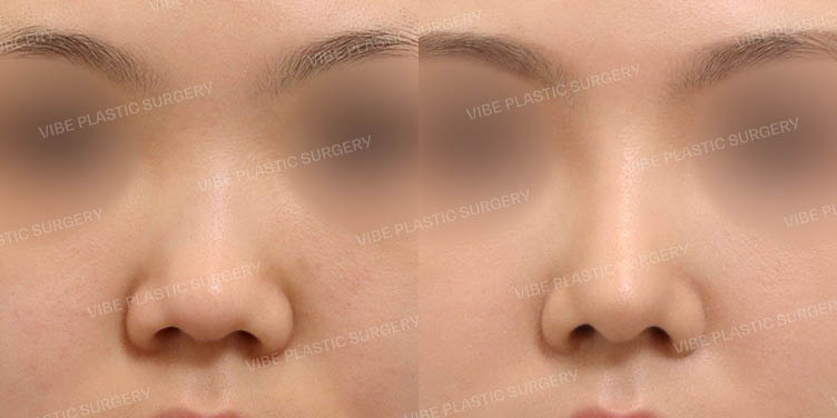 #짧은코 #복코 #비순각교정 #절골 #비절개콧볼축소