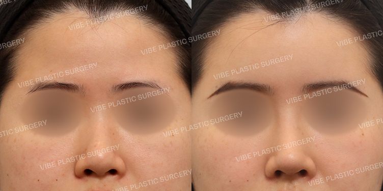 #낮은코 #이마지방이식