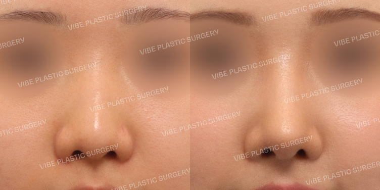 #무보형물 #코끝