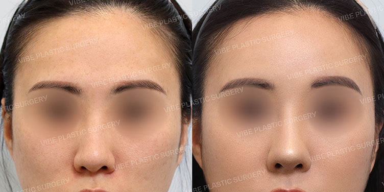 #풀페이스지방이식 #매부리코 #복코 #비중격연장이식 #비순각교정