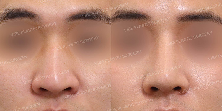 #매부리코 #휜코 #절골 #비중격연장이식 #기능코