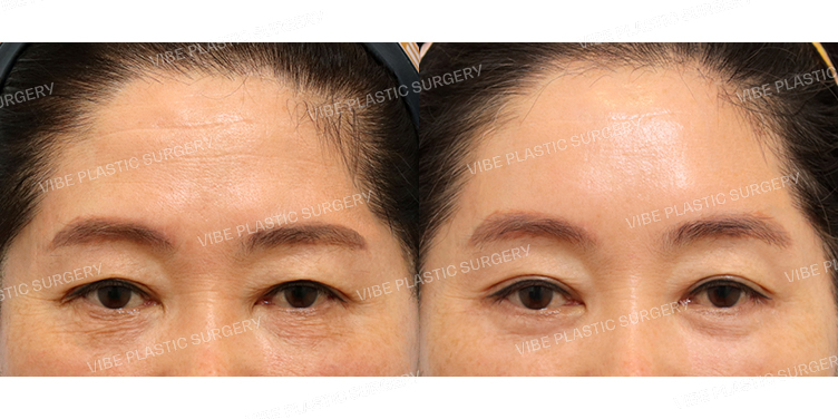 #내시경이마거상 #눈재수술 #자연유착 #하안검