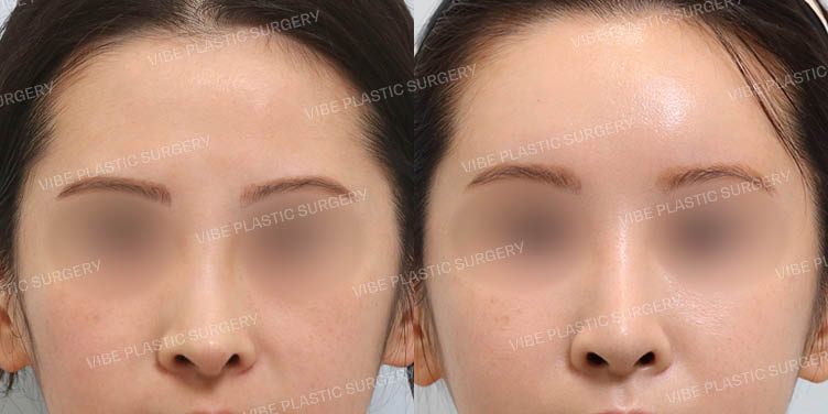 #코재수술 #보형물교체 #휜코 #긴코 #이마지방이식