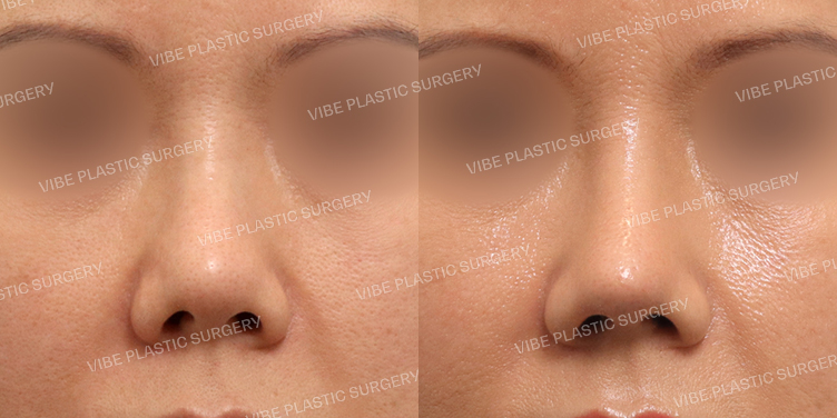 #짧은코(재수술)