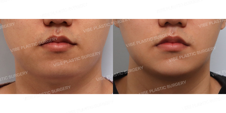 #초음파지방흡입(이중턱,턱라인) #사각턱보톡스 #턱끝필러