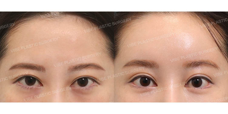 #내시경이마거상 #절개눈매교정(재수술) #뒤밑트임(재수술) #이마지방이식