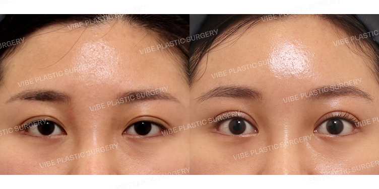 #부분절개눈매교정 #내시경이마거상