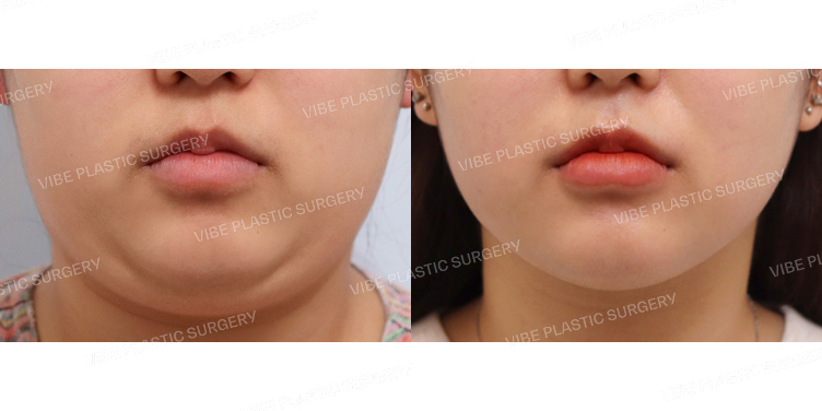 #초음파지방흡입(이중턱,턱라인)